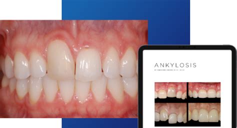 Ankylosis Part II: Treating Adults With an Ankylosed Tooth - Spear ...