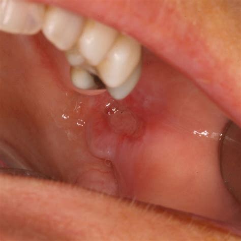 -Oral ulcer in buccal mucosa (mother) | Download Scientific Diagram