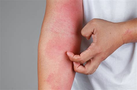 Penyakit Kulit Psoriasis – newstempo