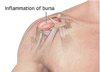 Shoulder Bursitis - NorthWest Physio