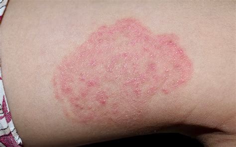 734 Images Of Viral Skin Infections free Download - MyWeb