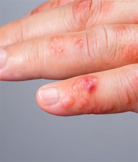 Scabies Burrows Fingers