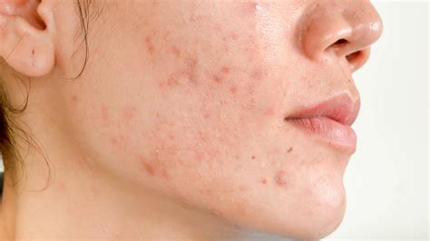 does adapalene fade acne scars - Sonia Murray