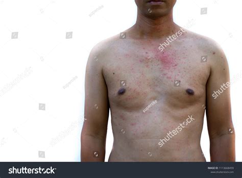 Rashes On Body Human Skin Stock Photo 1113668459 | Shutterstock