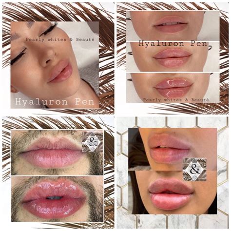 Hyaluron Pen Lip Filler Reviews - New Product Evaluations, Offers, and ...