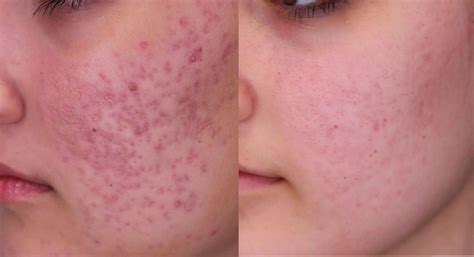 Professional Red Acne Scars Treatment Brisban - Cutis Dermatology