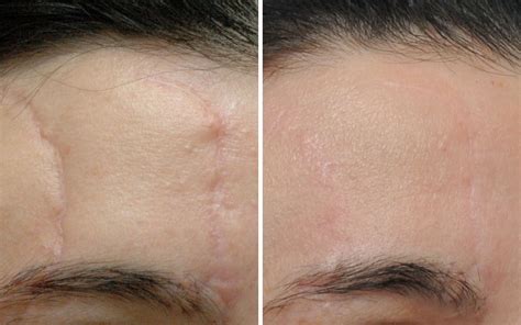 Scar Revision | Annapolis Plastic Surgery