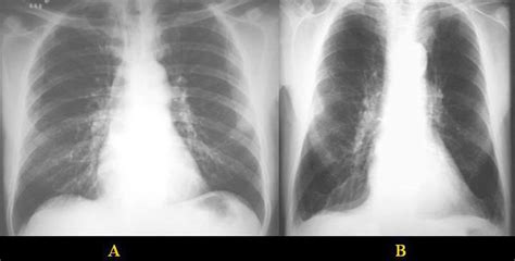 Emphysema - Causes, Signs, Symptoms, Stages, Expectancy & Treatment