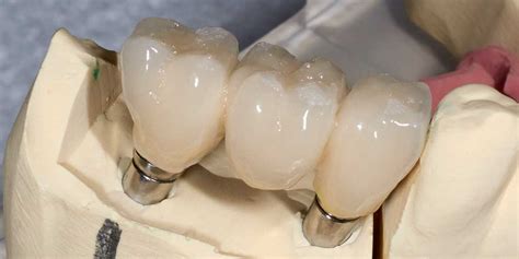 Dental Implant Supported Bridges CT | Smile Dental Center