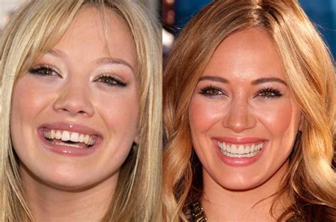 Know to the 33 Celebrities With Fake Teeth › The information was revealed