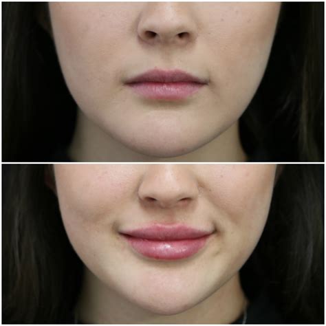 Plastic Surgery Lips Before After | Lipstutorial.org