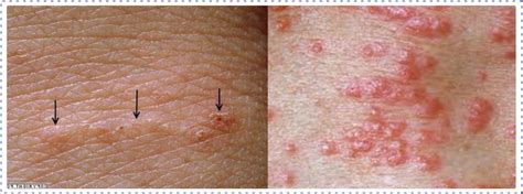 Scabies Adalah Penyakit - Homecare24