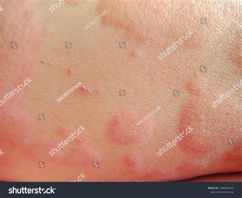 Rashes That Follow Human Body Stock Photo 1349481629 | Shutterstock