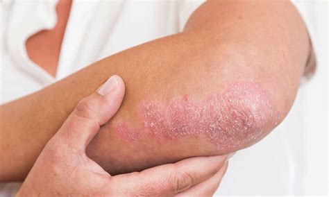 Penyakit Kulit Psoriasis – newstempo