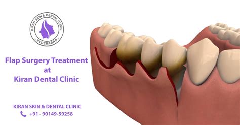 Flap Surgery Treatment in Hyderabad | Kiran Dental Clinic