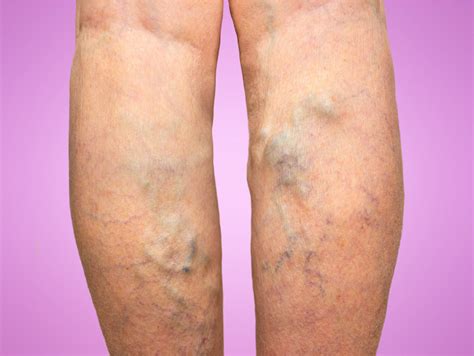 Varicose veins: Causes, Symptoms, Diagnosis and Treatments