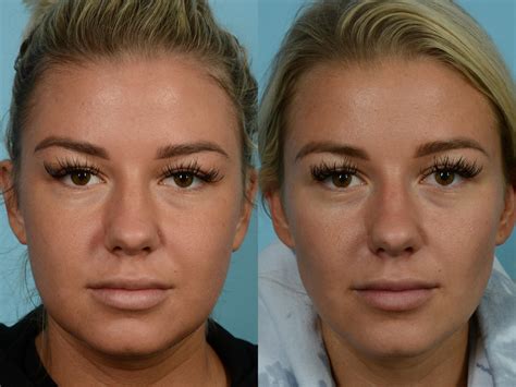 Buccal Fat Removal Before and After Pictures Case 714 | Chicago, IL ...