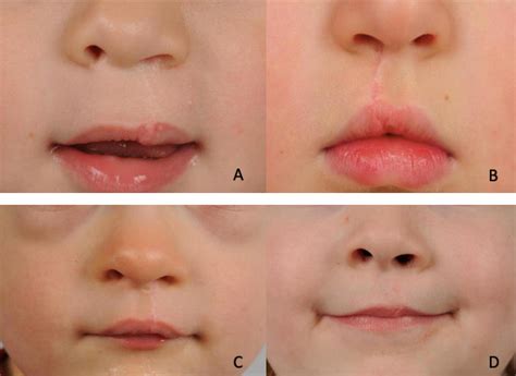 The role of scar massage in cleft lip surgery | Published in ...