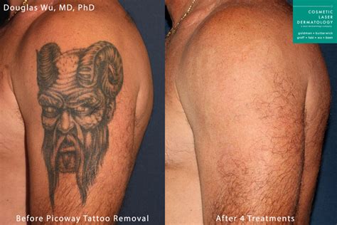 Laser Tattoo Removal Prices South Africa - Second Skin Tattoo