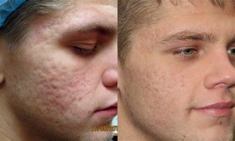 Our Top Tips On Treating Acne Scars - Jeune Ascot Vale