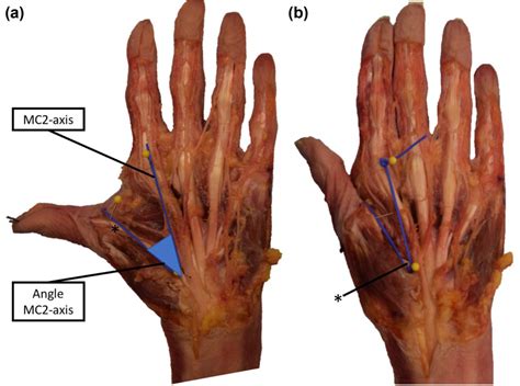 Abductor Pollicis Longus Cadaver