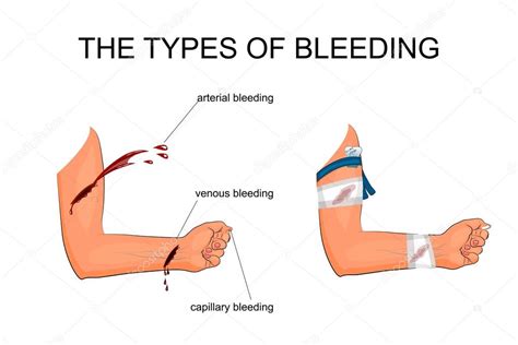 The types of bleeding — Stock Vector © Artemida-psy #113967188