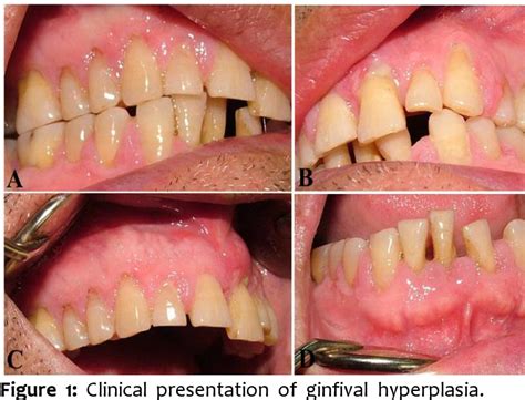 Figure 1 from A STUDY ON AMLODIPINE INDUCED GINGIVAL HYPERPLASIA ...