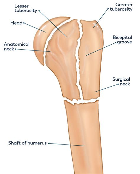 Surgical Humerus Of Arm