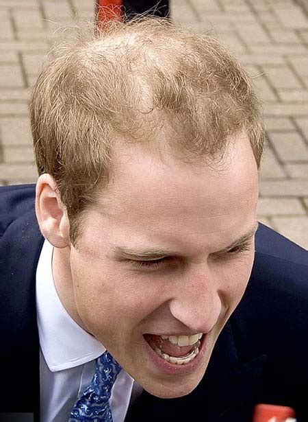 gineqovihi: prince harry hair loss