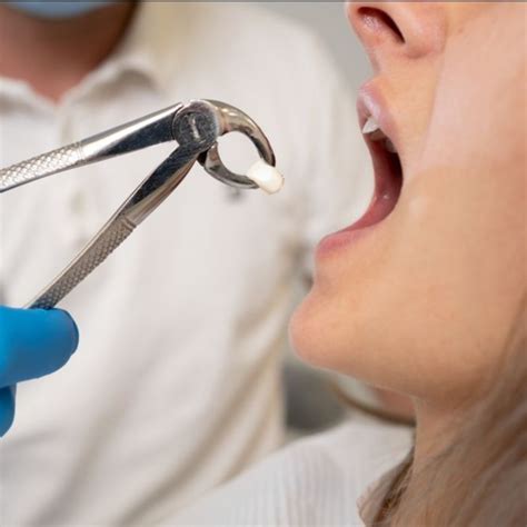 Ankylosed Tooth Extraction | Dentistry33