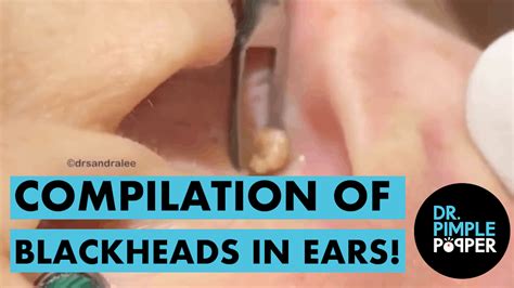 A Compilation of Blackheads in The EARS - Dr. Pimple Popper