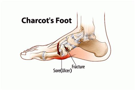 Charcot’s Arthropathy