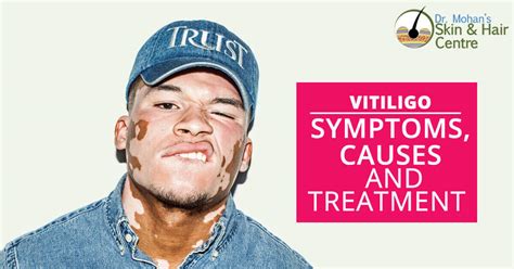 Vitiligo – Symptoms, Causes, And Treatment