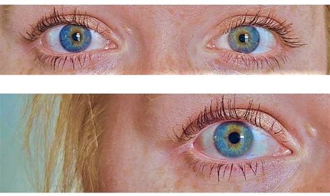 Central Heterochromia: Definition, Causes, and Types | Central ...