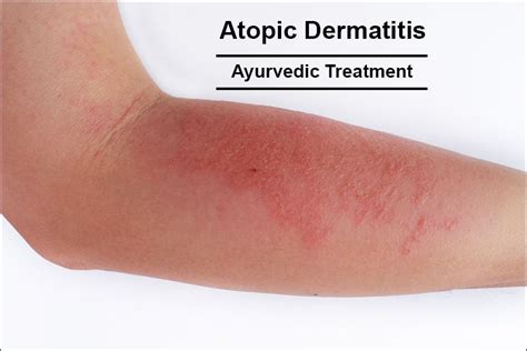 Japanese Guidelines For Atopic Dermatitis 2017, 54% OFF