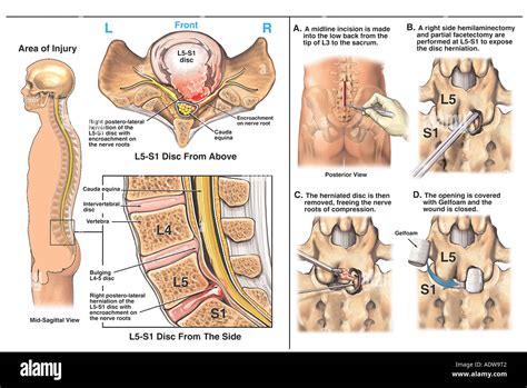 Back Surgery L5 S1 Disc Herniation with Hemilaminectomy Partial Stock ...