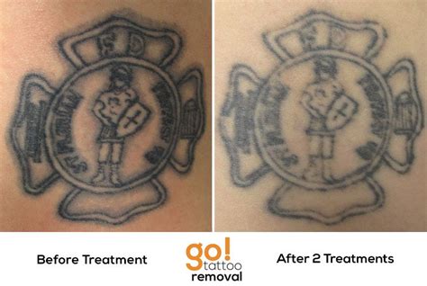 After two laser tattoo removal treatments the shading is gone and the ...