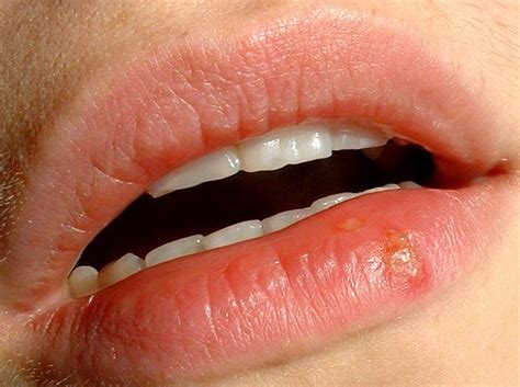 What causes mouth sores