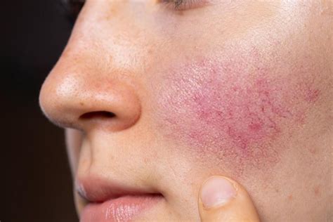 Help for Your Rosacea: Specialists In Dermatology: