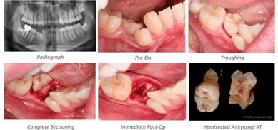 Ankylosed Tooth Extraction