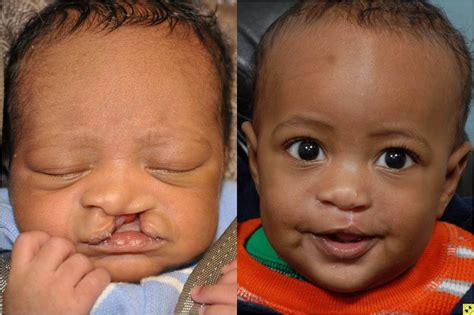 Cleft Lip Surgery Before And After