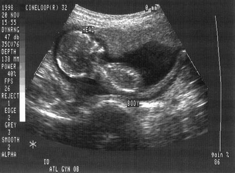 The History of Fetal Ultrasound | Pregnancy Imaging