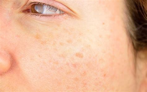 How to Treat and Remove Sun Spots on Your Face – Rx RAGA, LLC