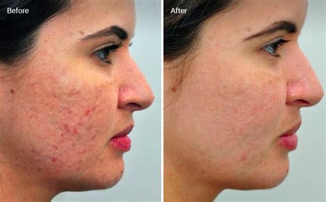 Laser Skin Resurfacing for Acne Scars: Efficacy, Before & Afters, Cost