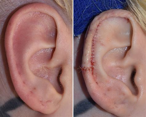 OR Snapshots - Vertical Ear Reduction with Scaphal Resection - Explore ...