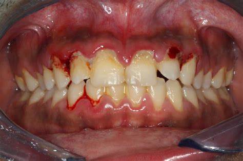 Acute necrotizing ulcerative gingivitis causes, symptoms, diagnosis ...