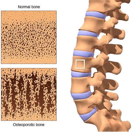 Bone Density Test - Scan Preparation, Cost, Results