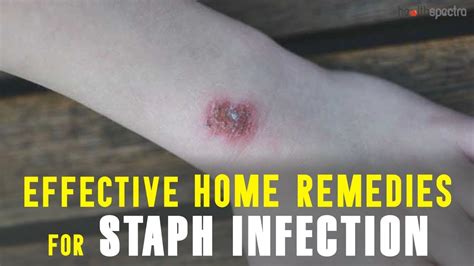 9 Effective Home Remedies for Staph Infection - YouTube