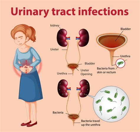 Uti Symptoms In Women