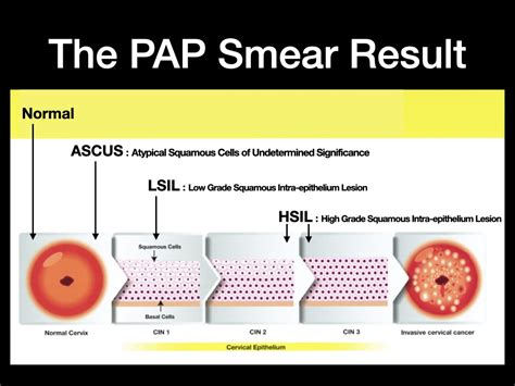 ASCUS PAP Smear & HPV - Anthony Siow